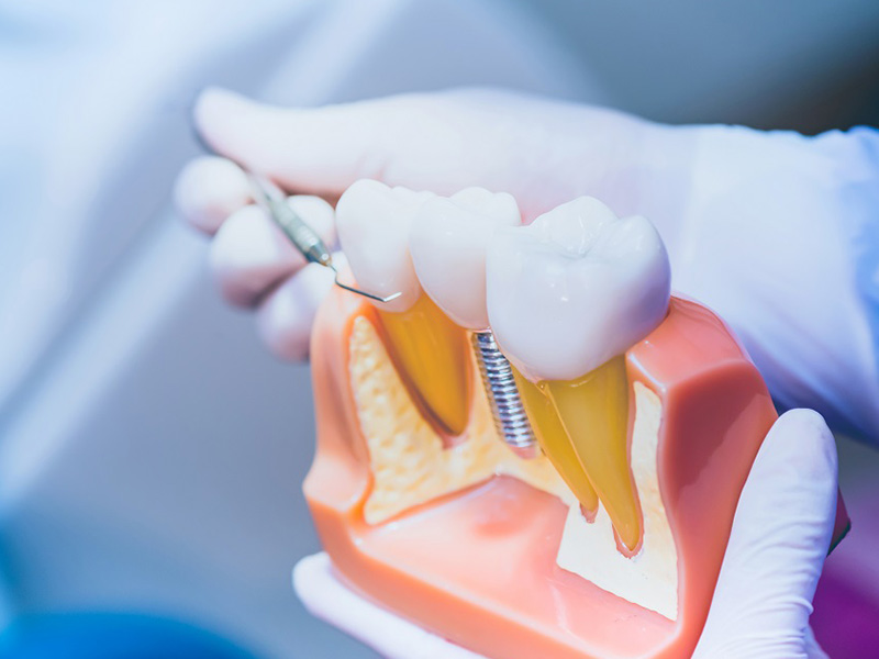 インプラント手術は痛みを伴いますか？