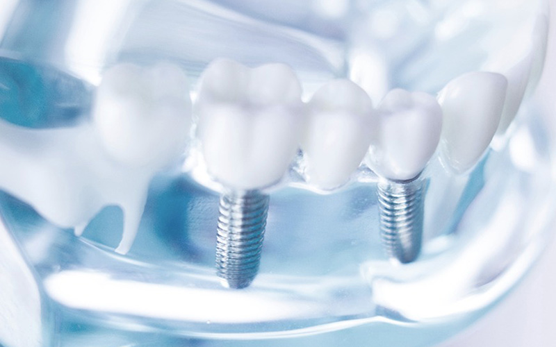 インプラントについて